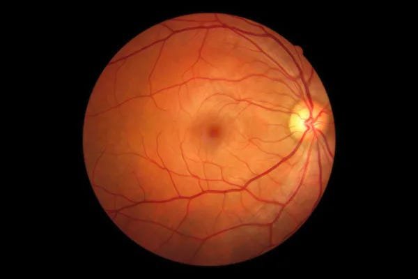 Artificial Retinas Could Address Vision Problems
